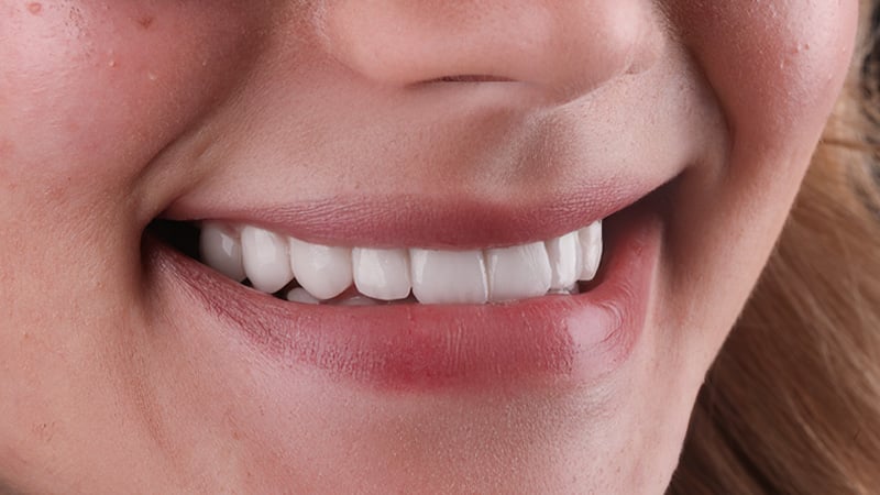  full smile restoration